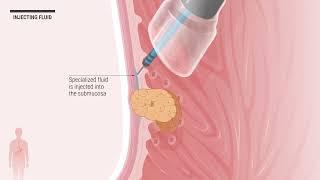 EFTR Endoscopic Full Thickness Resection