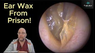 Ear Wax From Prison! 221 #ear #earwax #fyp #foryou #satisfying #asmr #foryourpage #foryoupage