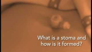 What is a stoma and how is it formed?