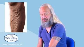 Patient Testimonial - Varicose vein procedure using The Whiteley Protocol® - Whiteley Clinics London