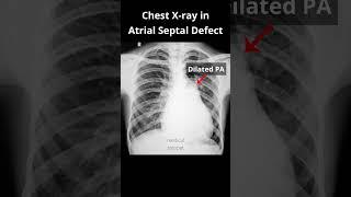 Chest Xray (Part 2) in Atrial septal defect (ASD) #shorts #asd #cxr