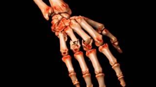 Metacarpals Fractured Hand