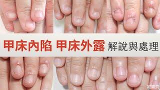 Inversion of the Nail Bed Exposure of the Nail Bed Exposure of the Fingernails - Treatment and