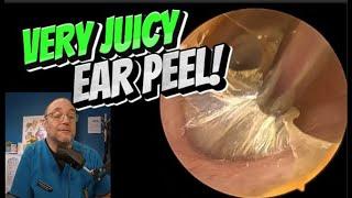 VERY JUICY EAR PEEL! 380 #ear #earwax #earwaxremoval #asmr   #satisfying #foryou #fyp #foryourpage