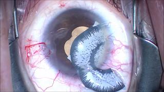 Change my eye color? Removal of BrightOcular Iris implant! J.T. Kavanagh MD