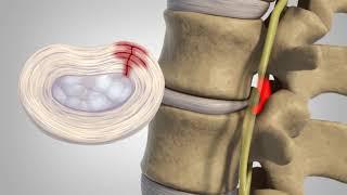 Herniated Disc - Patient Education