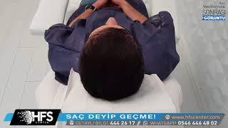 SAÇ EKİMİ SONRASI SAÇ SİMÜLASYONU İŞLEMİ