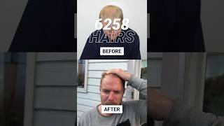 HIGH DENSITY hair transplant result | 2000+ grafts before and after