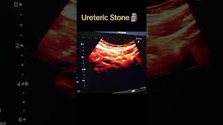 Mid ureteric Stone.