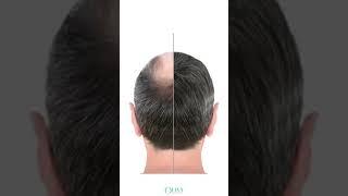 Hair Thinning | Is Stress A Reason For Hair Thinning? | Know From The Expert!