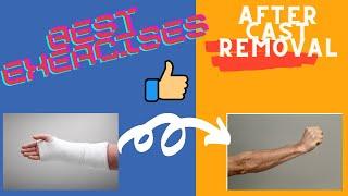 Broken Wrist Exercises after taking off Cast (Fingers-Physical Therapy