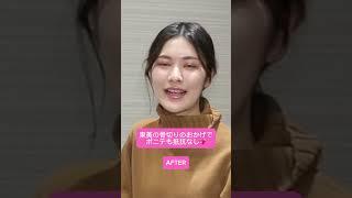 骨切りのおかげで避けていたポニーテールもできました#東京美容外科 #輪郭整形 #vライン形成  #小顔治療