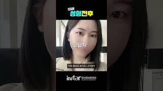 무쌍눈매교정으로 쌍꺼풀 없는 큰 눈 만든 후기 궁금하다면 !  #강남성형외과#무쌍눈매교정 #무쌍성형 #무쌍 #눈성형 #눈매교정 #눈매교정후기 #뒤트임 #밑트임 #뒤밑트임 #쌍수