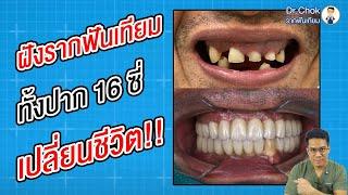 ฝังรากฟันเทียม ทั้งปาก 16 ซี่ เปลี่ยนชีวิต!! ทำโดย ทพ.ธนพงษ์ (หมอหนึ่ง) | คลายปัญหาฟันกับทีมหมอโชค