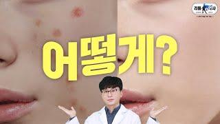 여드름, 피부트러블 없애는 방법 및 영양제 | 6가지 노하우 대공개