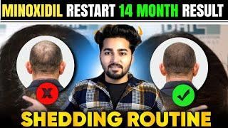 Minoxidil Restart 14 Month Results, Shedding, Routine