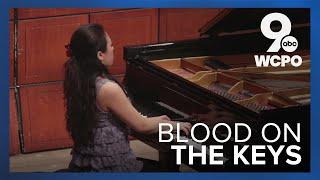 Bloody piano keys: Pianist says 'it doesn't hurt, actually'