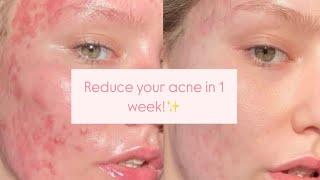 Clear Skin in 1 Week: Acne Treatment That Actually Works!