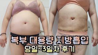 복부 대용량 지방흡입 당일~3일차 후기 영상 (지방량 5000cc!! 3일의 기적)