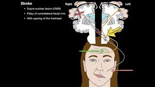 Bells Palsy and Stroke