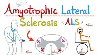 Amyotrophic Lateral Sclerosis (ALS) -  Lou Gherig disease - UMNL & LMNL - Paralysis - Neurology