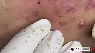 Big Cystic Acne Blackheads Extraction Blackheads & Milia, Whiteheads Removal Pimple Popping