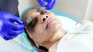 Korean glass glow procedure - Face Instant Glow Treatment