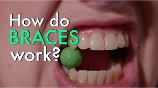 How Do Braces Work?