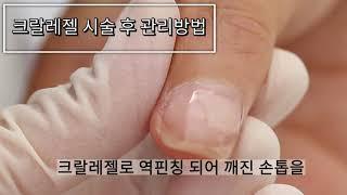 크랄레젤케어후 관리하는 방법!Krallegel care after do management way