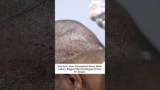 first head wash after hair transplant | How To Wash Your Hair After Hair Transplant | Skinaa Clinic