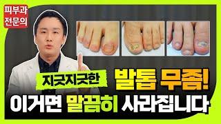 발톱무좀 치료? 피부과 전문의가 확실하게 말해드립니다