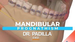 Mandibular Prognathism - Dental Designs Health Tip