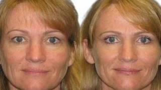 Upper Eyelid Blepharoplasy - Dr. Bitner