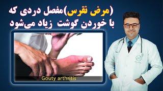 مرض نقرس، مفصل دردی که با خوردن گوشت زیاد می شود| داکتر قیس نیکزاد