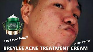 BREYLEE ACNE TREATMENT CREAM  REVIEW IN 3 DAYS