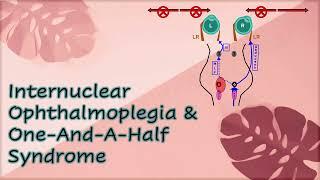 Internuclear Ophthalmoplegia & One And A Half Syndrome