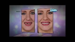 Perfect Smile Veneers Commercial - As Seen on TV