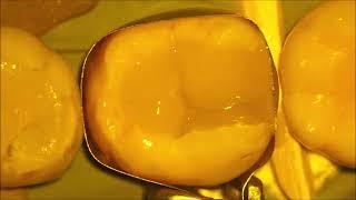 GC EverX Flow- flowable dental composite for Post endo core build up by Rudolf Novotny