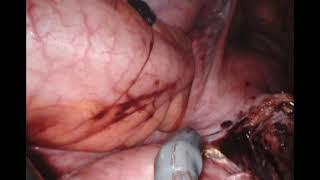 Robotic Myomectomy of a 600 g Fibroid