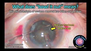 CataractCoach™ 2312: What does "bowl it out" mean with cataract surgery?