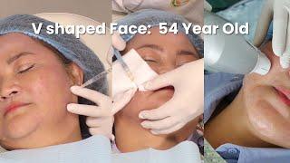 V shaped Face treatments on a 54-Year Old female