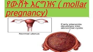 የውሸት እርግዝና ( mollar pregnancy ) ምንድነው ??