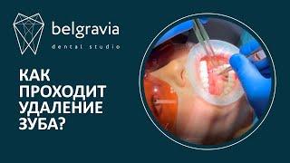  Как проходит удаление зуба в стоматологии Belgravia Dental Studio