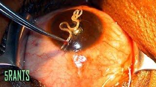 5 Disgusting Parasites  Ever Found Living Inside Human Body