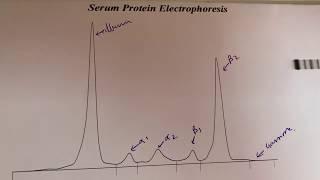 IgG lambda monoclonality/multiple myeloma,protein electrophoresis and immunotyping for myeloma