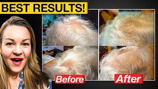 Natural hair loss treatments compared: Red light v Calecim v Growband!