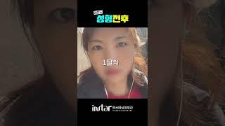 쌍꺼풀 제거, 쌍수 제거, 쌍꺼풀 없애기 수술 ? 고민중이라면 ! 