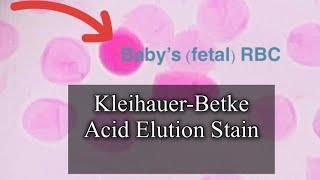 Kleihauer-Betke Stain to detect Fetal-Maternal Hemorrhage