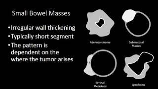 Small Bowel Masses