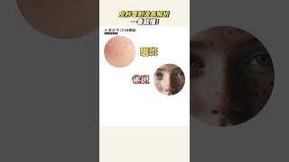不知道自己該打哪一種皮秒嗎? 不同的皮膚狀況，要選擇相對應的雷射才有效唷! #醫美#雷射#皮秒